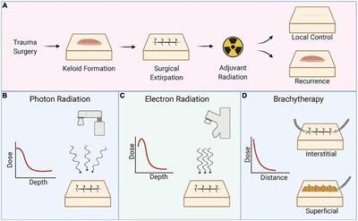 Current advances in the selection of adjuvant radiotherapy regimens for keloid